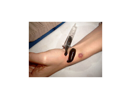 Blutegel Therapie