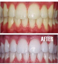 Zahnbleaching
