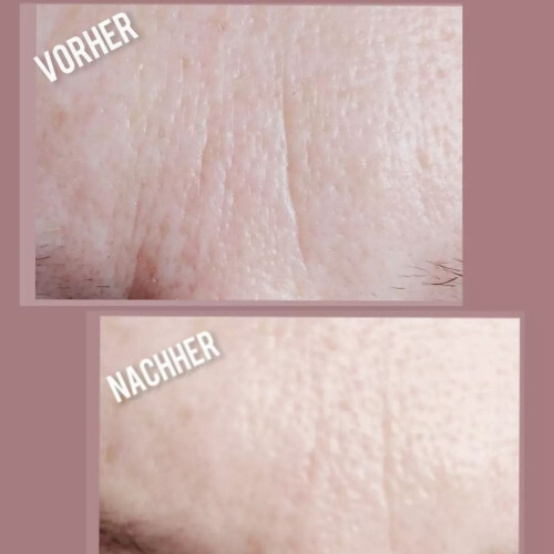 Microneedling