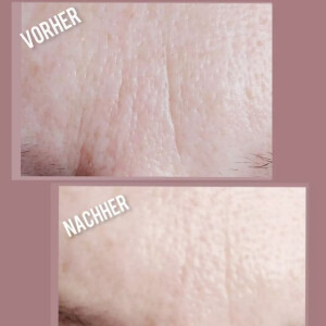 Microneedling