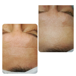 Microneedling