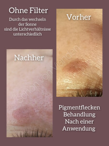 Pigmentflecken Behandlung