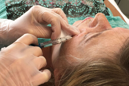 Augenringe Hyaluronspritzung.jpg