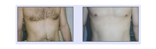 Haarentfernung VN 3.jpg