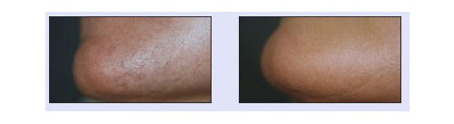 Haarentfernung VN 2.jpg