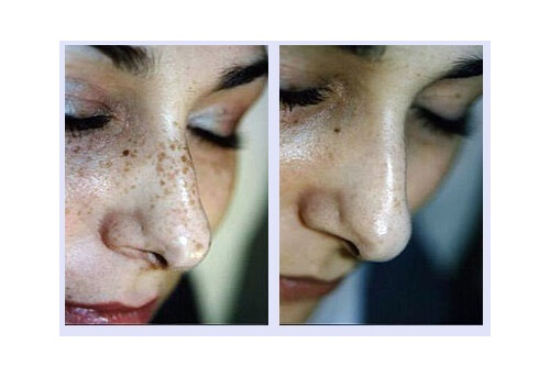 Pigmentflecken VN 2.jpg