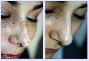 Pigmentflecken VN 2.jpg