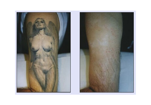 Tattooentfernung VN 5.jpg