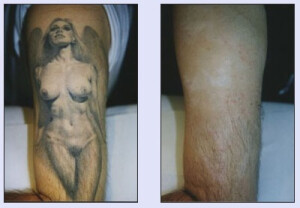 Tattooentfernung VN 5.jpg