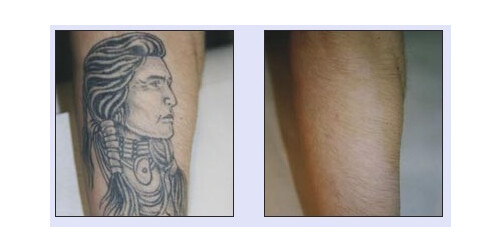 Tattooentfernung VN 1.jpg