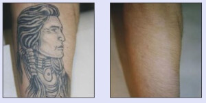 Tattooentfernung VN 1.jpg