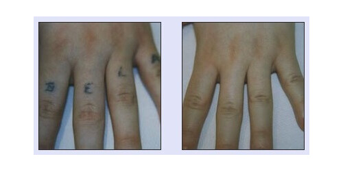 Tattooentfernung VN 4.jpg