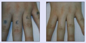 Tattooentfernung VN 4.jpg