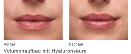 Volumenaufbau mit Hyaloron