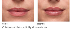 Volumenaufbau mit Hyaloron