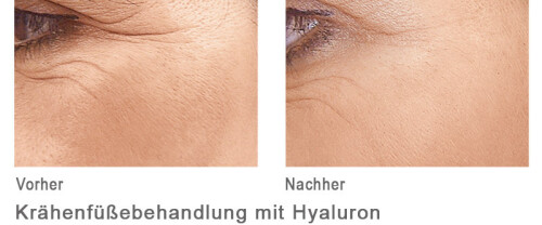Kraehenfueßebehandlung mit Hyaloron