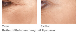 Kraehenfueßebehandlung mit Hyaloron