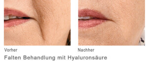 Faltenbehandlung mit Hyaloron