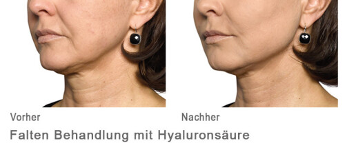 Faltenbehandlung mit Hyaloron