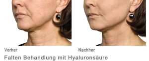 Faltenbehandlung mit Hyaloron