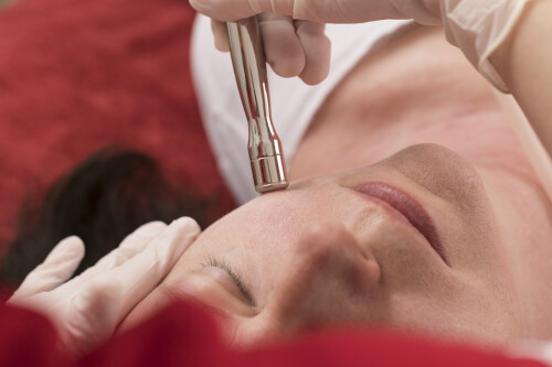 Diamantmicrodermabrasion