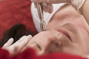 Diamantmicrodermabrasion