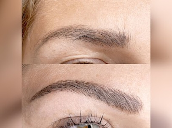 Brow Lifting